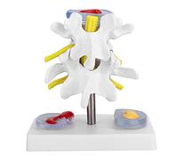 1:1.5 Modello Anatomico di Ernia del Disco Umano, Vertebre Modello Degenerativo della Colonna Vertebrale Umana Lombare Modello Dimostrativo Medico Modello del Disco Lombare Umano Per L'insegnamento Li