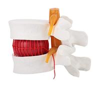 1: 1.5 Modello di dimostrazione dell'ernia del disco Modello medico della colonna vertebrale lombare Modello di studio Modello della colonna vertebrale vertebrale lombare Impara l'educazione fisica