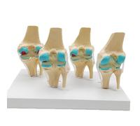1 pz Modello anatomico dell'articolazione del ginocchio patologico umano a quattro stadi Risorse didattiche for la scienza medica Dropshipping