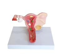 1 pz Modello patologico Femminile dell'apparato riproduttivo dell'utero Modello anatomico della Vagina for l'insegnamento Medico