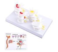 1 Set Lesione Lombare Umana Della Colonna Vertebrale Statua Display Modello di Insegnamento Medico Apprendimento