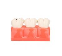 2024 New,dental Caries Model Tooth Decay Demonstration Model Simulation Detachable Teeth Model