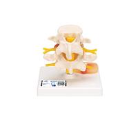 3B Scientific A76 Modello di Vertebre Lombari con Ernia al Disco + software gratuito di anatomia - 3B Smart Anatomy