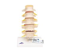 3B Scientific A795 Stadi dell'Ernia del Disco Intervertebrale e Degenerazione della Vertebra + software gratuito di anatomia - 3B Smart Anatomy