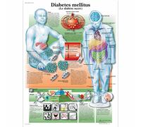 3B Scientific Diabete Tavola Didattica Anatomica su Carta, Multicolore, 50 x 67 cm