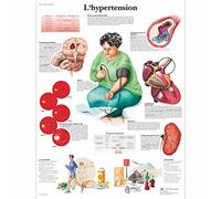 3B Scientific Ipertensione Arteriosa Tavola Didattica Anatomica su Carta, Multicolore, 50 x 67 cm
