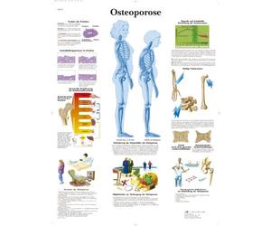 3B Scientific Lavagna didattica laminata - osteoporosi, VR0121L