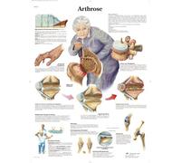 3B Scientific Lehr lavagna - artrosi, 1