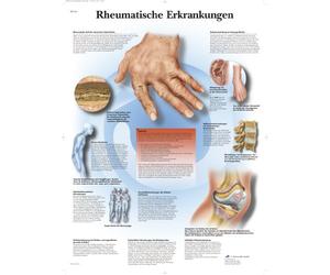 3B Scientific Lehr lavagna laminato - Reumatismi tische malattie, 1