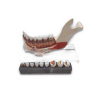 3B Scientific modello mandibola mezza mandibola 8 denti cariosi 19 pezzi