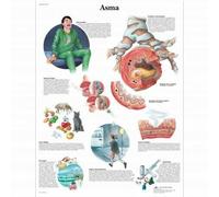 3B Scientific, tavola anatomica, Asma (cod, VR4328UU)