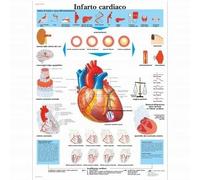 3B Scientific, tavola anatomica, Infarto Cardiaco (cod, VR4342UU)