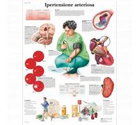 3B Scientific, tavola anatomica, Ipertensione Arteriosa (cod, VR4361UU)
