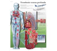 3B Scientific VR3368L stampato in carta, trombosi venosa profonda