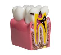6 volte Caries Dente Modello dente Dentenza per l'educazione e la