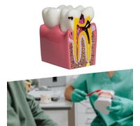 6 volte Caries Dente Modello di insegnamento Struttura di apprendimento Resina