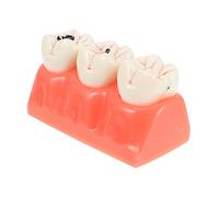 ABOOFAN Modello Anatomico Dente Carie per Studio e Dimostrazione Odontoiatrica Struttura Chiara per Insegnamento e Ricerca Professionale