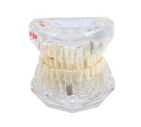 Alide Modello Dentale Tipodontico, Modello Dentale Trasparente Standard Con Impianti E Denti Rimovibili, Insegnamento Della Patologia Dentale Per Dimostrazione Anatomica