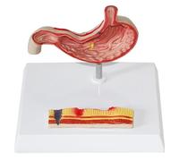 Anatomia umana Stomaco, Stomaco perforato Modello di patologia dello stomaco, Patologia dello stomaco Gastrite Ulcera Medicina Strumento di insegnamento e apprendimento