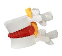 Assistenza didattica ernia del discorso del disco, modello del corpo umano in PVC del disco di vertebre lombari erniata, 1,5 volte modello di colonna lombare per l'insegnamento, l'apprendimento e la