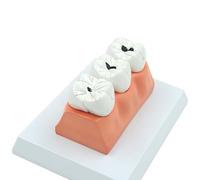 ATJSXWIN Carie Dentale Modello anatomico, Staccabile Dente Modello, Carie Modello patologico per la Medicina Dentale insegnamento