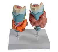 ATJSXWIN Umano tiroide patologia Modello 4 Parti, tiroide Anatomia Modello Mostra Il tumore della tiroide, Cancro della tiroide, malattia di Graves