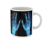 Awowee Tazza da caffè con radiografia X Ray di entrambe le mani umane in osso malato, tazza da tè in ceramica da 325 ml, miglior regalo o souvenir per familiari, amici e colleghi