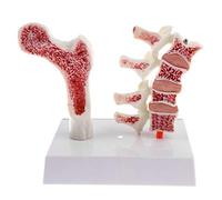 Backbayia 1: 1 modello di patologia l'osteoporosi dell'osso della vertebre lombare in PVC con base