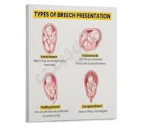 Breech Fetal Positions Poster Diagnosis and Types Chart for Emergency Obstetrics and Training Programs Canvas(Framed,12x18inch(30x45cm))