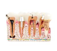 buyzg Modello di carie dentale da 2 pezzi con nervo per la comunicazione tra paziente e medico, modello di carie dentale, 6 modelli anatomici didattici per la dimostrazione didattica