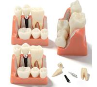 buyzg Modello di denti con impianto dentale 3 pezzi, modello di corona e ponte con impianto dentale staccabile 4 volte per presentazione educativa, ausilio didattico, modelli medici