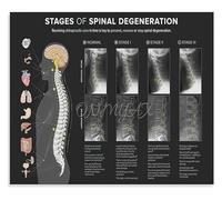 BYCIFRLG Spinal Degeneration Chart Level Demonstration Vertebral Subluxation Anatomy Educational Poster Canvas Print Wall-Art for Chiropractic Office Decor(Framed,12x18inch(30x45cm))