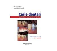 Carie dentali. Malattia e trattamento clinico. Ediz. illustrata