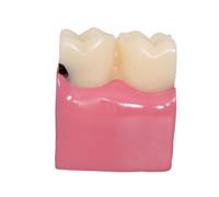 Caries Dente Model Education Forniture 6 Volte Per Gli Studenti Che Studiano I