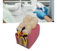 Caries Dente Modello 6 Volte ROOTS Canale Morfologia DOTTO INSEGNAMENTO RESINA