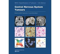 Central Nervous System Tumours: Who Classification of Tumours
