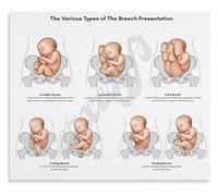 Childbirth Variations Poster Breech Presentation Types and Management Guide for Birth Center Canvas Wall-Art(Unframed,16x24inch(40x60cm))