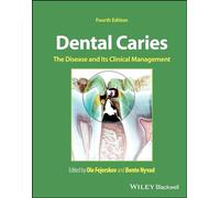 Dental Caries: The Disease and Its Clinical Management