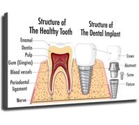 Dental Implant Educational Poster Tooth Anatomy Wall Art