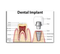Dental Implant Surgery Educational Poster, Step by Step Anatomy Chart, Wall Reference for Dentists and Students(Unframed,08X12inch(20X30cm))