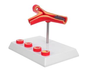 di blocco vascolare - Simulazione del di flusso sanguigno