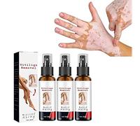 DUBUSH Spray lenitivo alla vitiligine da 30 ml, Spray per la Riparazione della Pelle alla vitiligine, Spray per la Cura della vitiligine per la Cura della Pelle, Riduce Le Macchie Bianche sulla Pelle