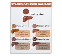 Educational Wall Art Metal Tin Sign Liver Health and Anatomy Knowledge Chart Poster for Room Aesthetic Decor(Unframed,08x12inch(20x30cm))