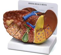 Fegato con Modello di Patologie, Modello di Fegato Replica di Anatomia del Corpo Umano del Fegato con Patologie per Lo Strumento Educativo Dell'ufficio dei Medici