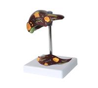 Fegato Patologia Modello Malattia Cirrosi Grassa Scuola Medica Insegnamento