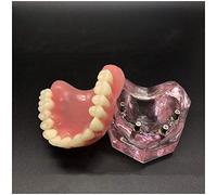 FHUILI Denti Trasparenti Implant Model - Denti dentali Studio Modello di insegnamento - Denti Overdenture Superiore 4 impianti Demo Modello - per Studio Medico Modello di insegnamento,A