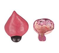 FHUILIJH Vescica Sana e Modello anatomico della vescica patologica Modello dimostrativo comparativo della vescica a Tubo Rimovibile,Flesh,20cm