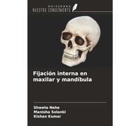 Fijación interna en maxilar y mandíbula