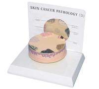 FITIOS Modello di patologia del Cancro della Pelle - Strumento didattico di Anatomia della Pelle Umana ingrandita for la dermatologia e la Formazione Medica - Dimostrazione della Regola ABCDE