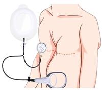 FXNFXLA Pectus Excavatum Correttore Per Adulti E Adolescenti - Tutore toracico Non Chirurgico a Imbuto, Correzione Delle Deformità Della Parete Torace, Correzione Fisica Del Seno Per Tutte Le Età S
